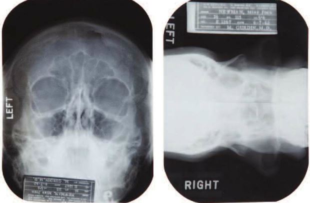 marilyn_monroe platic surgery