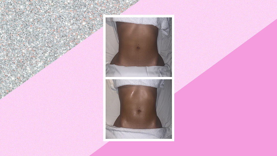 lymphatic drainage massage before and after