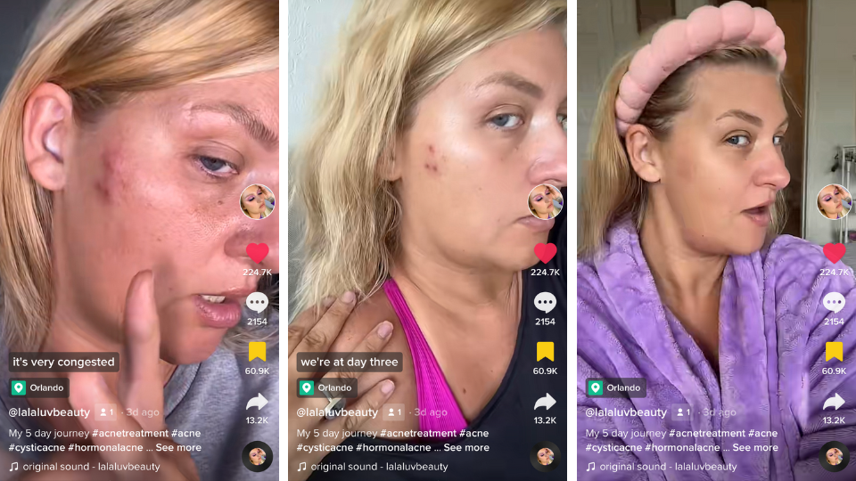 murad acne treatment